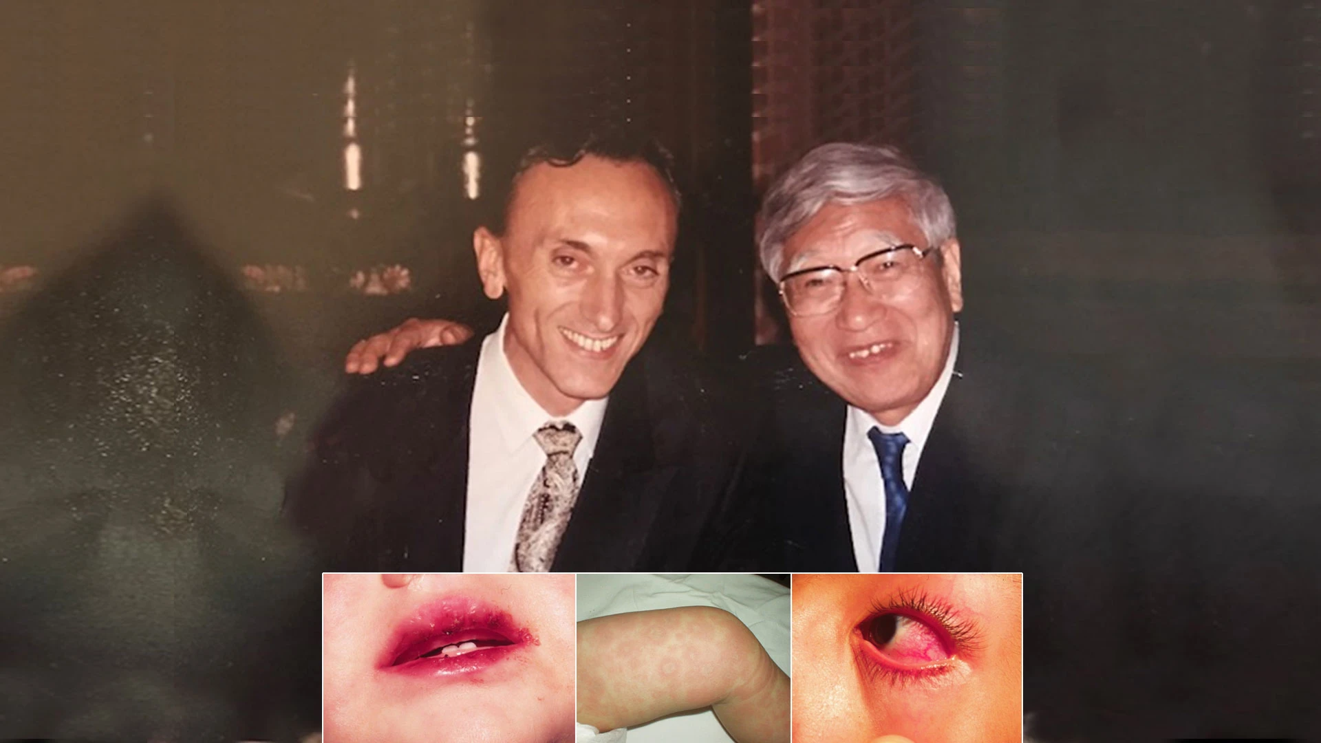 El doctor Rubén Cuttica junto a Tomisaku Kawasaki en un simposio sobre la enfermedad descrita por el japonés.