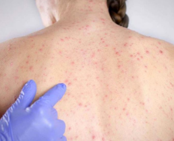 Alerta epidemiológico en CABA por un posible caso de sarampión detectado en una embarazada que volvió de un viaje en Maldivas