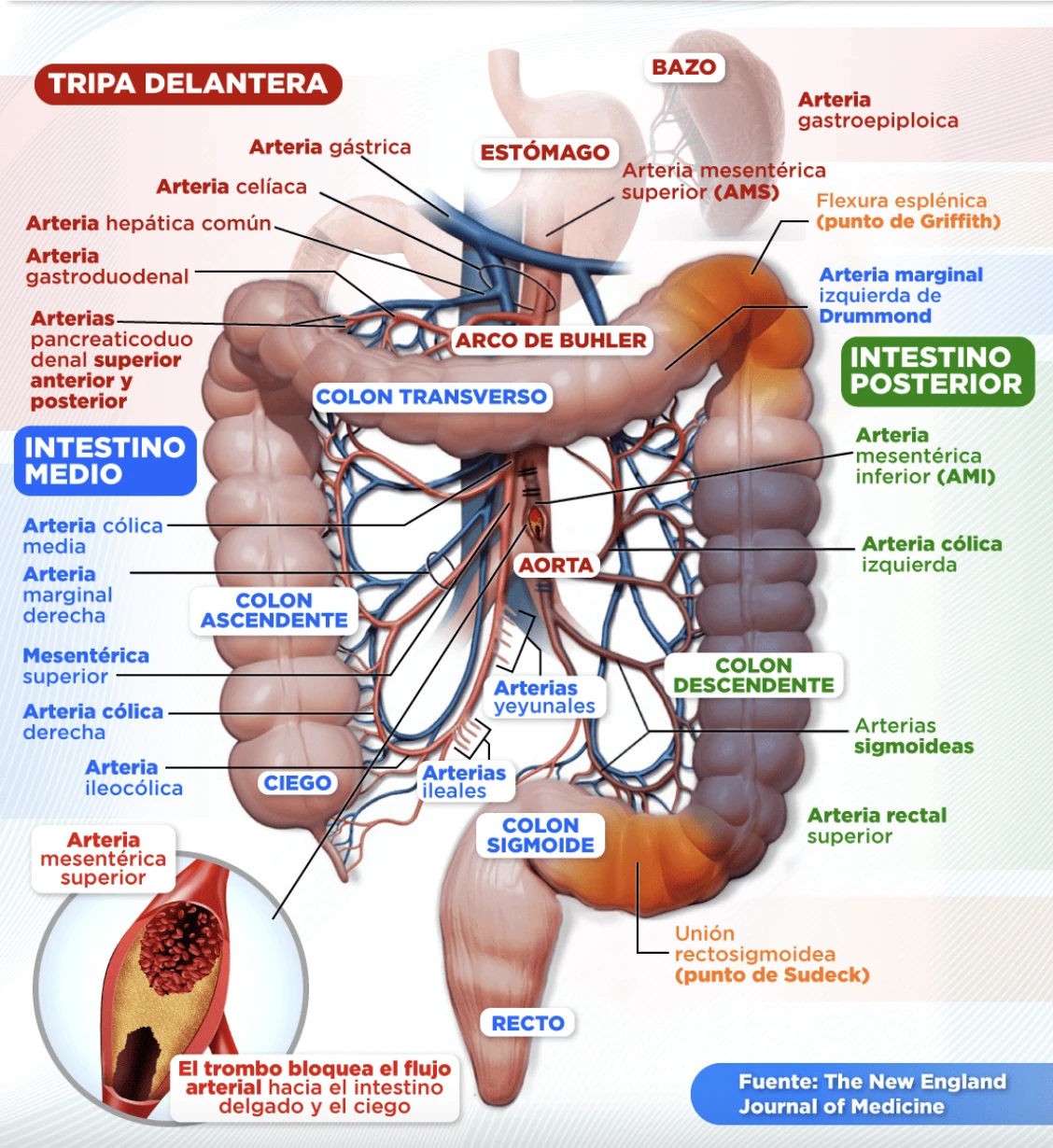 Así se presenta la isquemia intestinal. 